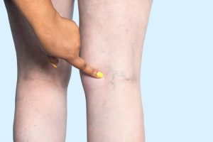 Chronic Venous Insufficiency