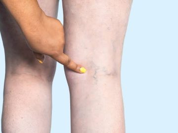 Chronic Venous Insufficiency